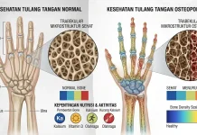 Jaga Kepadatan Tulang sejak Dini Melalui Kebiasaan Berikut Ini