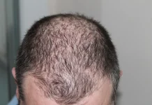 Penyebab Rambut Menipis pada Pria, Ketahui Cara Mengatasinya