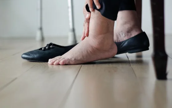 Berikut 5 Cara Mengurangi Pembengkakan Kaki Secara Alami