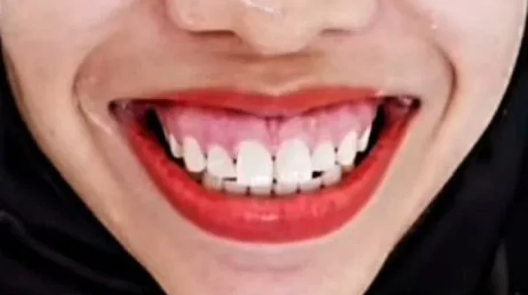 Gummy Smile Bisa Ganggu Kesehatan Gusi dan Gigi