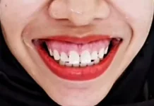 Gummy Smile Bisa Ganggu Kesehatan Gusi dan Gigi