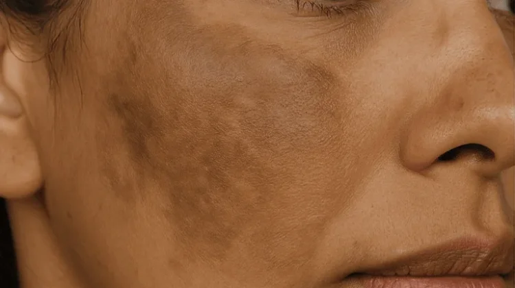 Cara Ringan Atasi Melasma Wajah