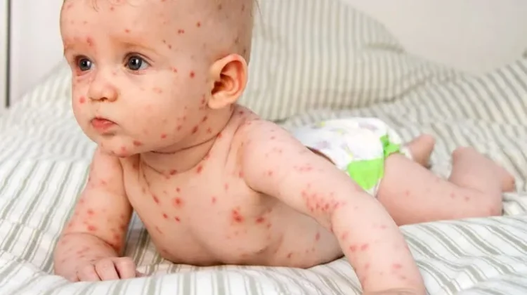 Orang Tua Perlu Mengenal Alergi Anak