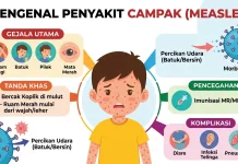 Kenali, Cegah dan Lindungi dari Ancaman Campak