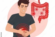 Waspada Gejala awal Kanker Usus sejak Dini