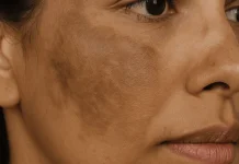 Cara Ringan Atasi Melasma Wajah