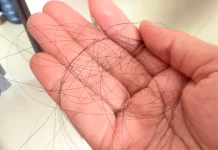 Waspadai Rambut Rontok Berlebihan pada Wanita Usia Muda