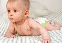 Orang Tua Perlu Mengenal Alergi Anak