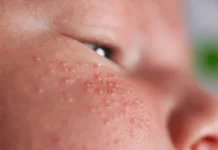 Jerawat Bayi Umumnya sementara dan Bisa Hilang tanpa Pengobatan
