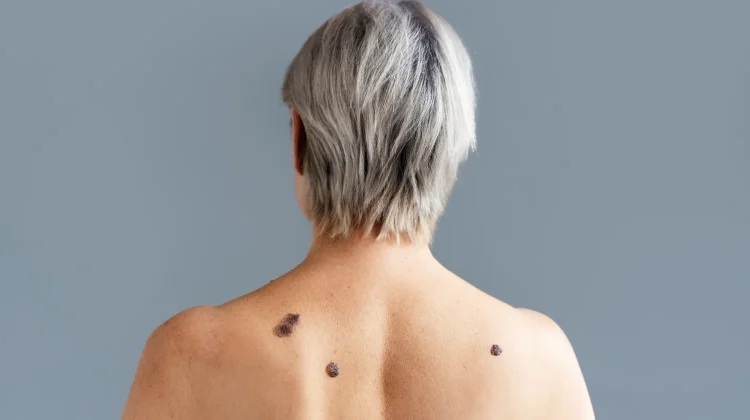 Apa Itu Skin Tag, Kenali Benjolan Kecil yang Sering Muncul di Kulit