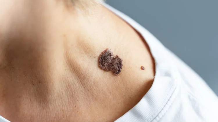 Apakah Skin Tag Berbahaya, Ini Fakta Medisnya