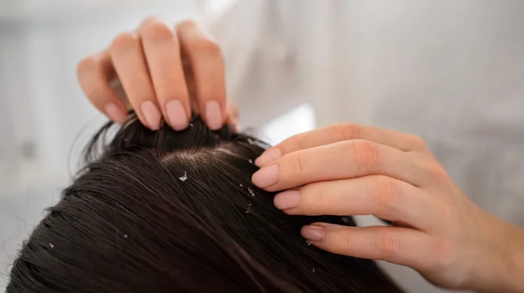 Mengenal Dermatitis Seboroik: Penyakit Kulit yang Sering Disalahartikan sebagai