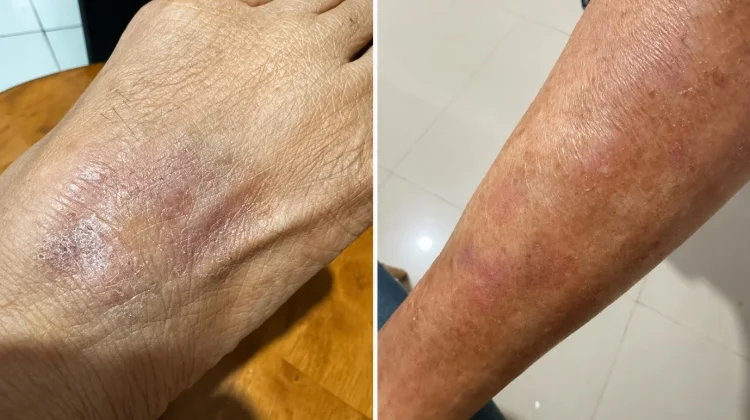 Waspadai Penyakit Kulit dan Cara Tepat Menanganinya