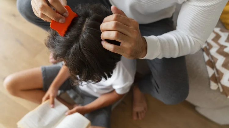 Bukan karena Jorok, Ini Fakta Tentang Kutu Rambut yang Wajib Tahu