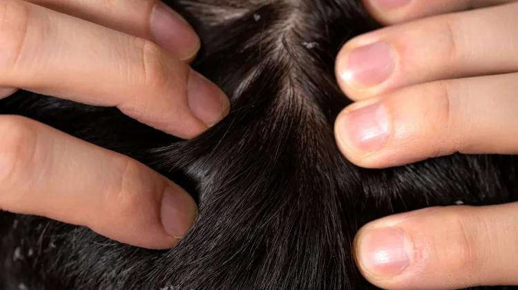 Tips Mencegah Kutu Rambut Datang Lagi setelah Diobati