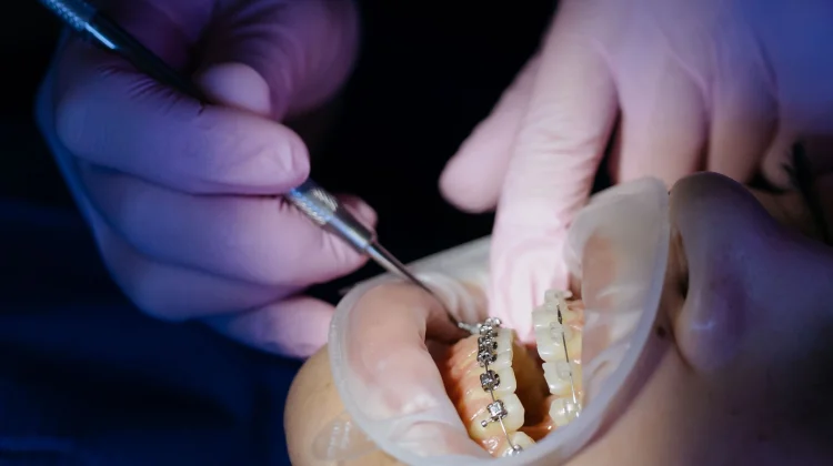 Kenapa Pasang Behel Harus di Orthodontis, Ini Alasannya