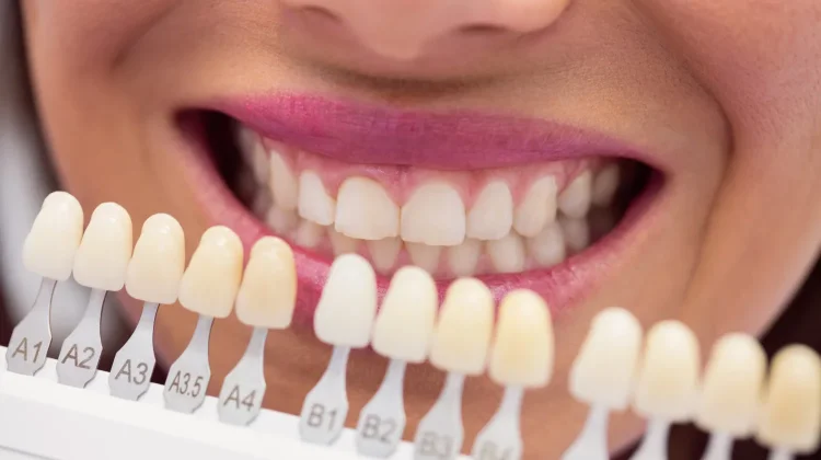 Mengenal Veneer Gigi: Fungsi, Prosedur, dan Perawatannya