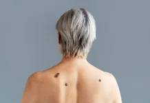 Apa Itu Skin Tag, Kenali Benjolan Kecil yang Sering Muncul di Kulit