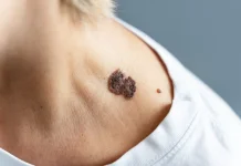Apakah Skin Tag Berbahaya, Ini Fakta Medisnya