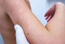 Kenali Penyebab Penyakit Autoimun