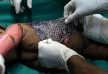 Perban Kulit Ikan untuk Penyembuhan Luka Bakar