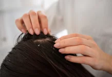 Mengenal Dermatitis Seboroik: Penyakit Kulit yang Sering Disalahartikan sebagai