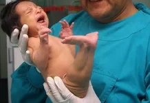 Mengenal Sirenomelia atau Sindrom Putri Duyung pada Bayi Baru Lahir