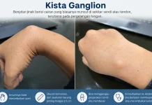 Mengenal Kista Ganglion dan Gejalanya