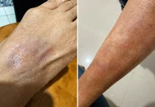 Waspadai Penyakit Kulit dan Cara Tepat Menanganinya