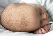 Tips Ampuh Menghilangkan Kerak Kuning di Kulit Kepala Bayi