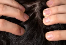 Tips Mencegah Kutu Rambut Datang Lagi setelah Diobati