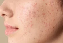 Penyebab Bekas Jerawat Bertahan Lebih Lama