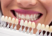 Mengenal Veneer Gigi: Fungsi, Prosedur, dan Perawatannya
