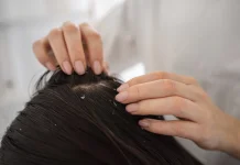 Ketahui Penyebab Ketombe yang Jarang Orang Ketahui