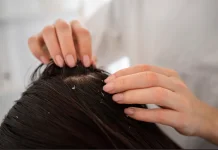 Cara Efektif Menghilangkan Ketombe Secara Alami