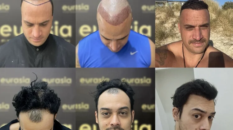 Teknologi Transplantasi Rambut Modern Hadir di Yogyakarta