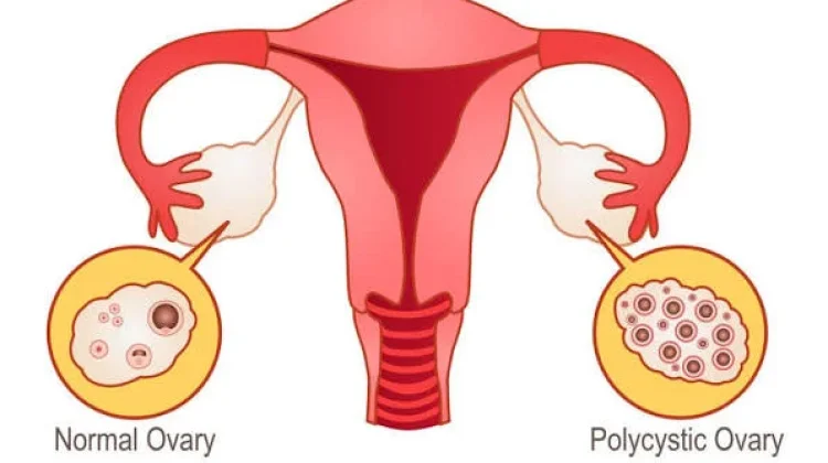PCOS Kini Disebut PMOS, Kenali Kondisi dan Gejalanya