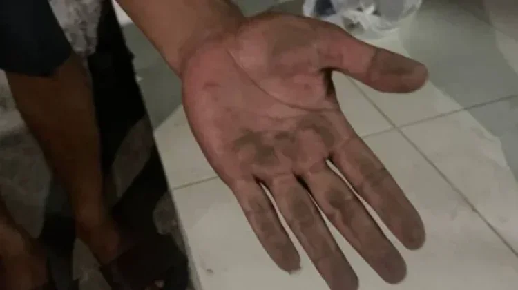 Kemenkes Ingatkan Bahaya Paparan Abu Vulkanik pada Kulit