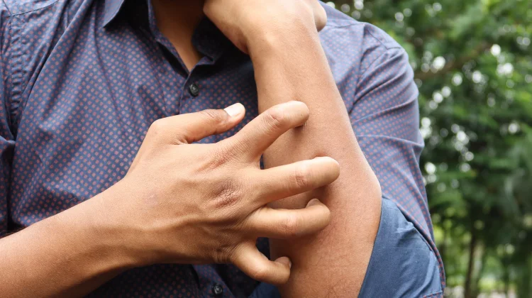 Apa Itu Eksim? Kenali Ciri-Ciri dan Penyebabnya