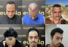 Teknologi Transplantasi Rambut Modern Hadir di Yogyakarta