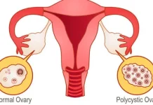 PCOS Kini Disebut PMOS, Kenali Kondisi dan Gejalanya