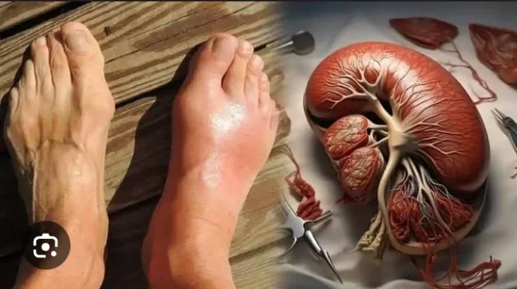 Hubungan Asam Urat dan Kesehatan Ginjal