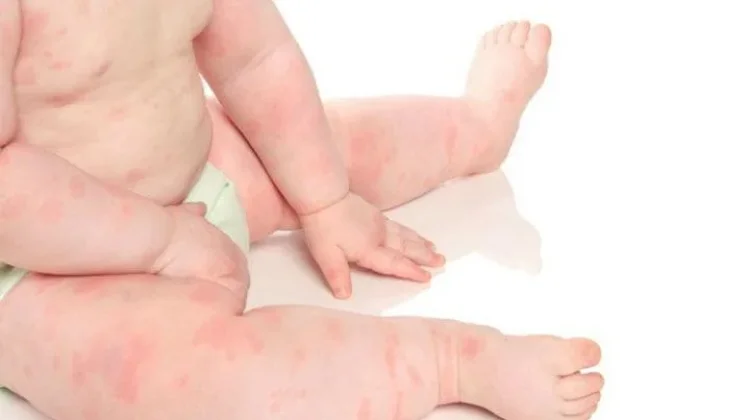 Tips Mengobati Biduran pada Anak