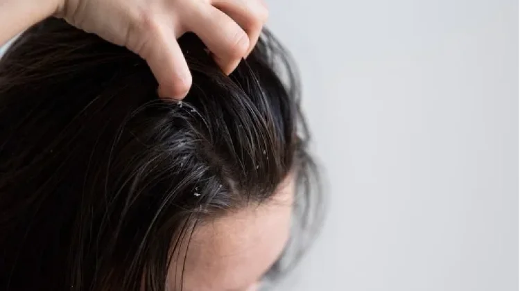 5 Cara Merawat Kulit Kepala yang Sensitif