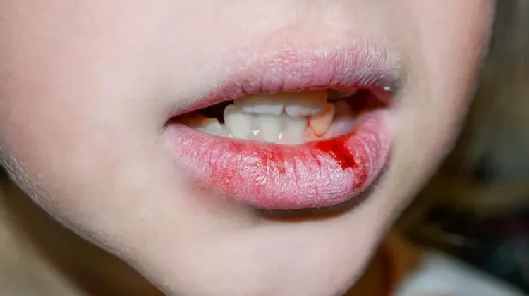 Tips Menjaga Bibir Tetap Sehat dan Tidak Pecah-Pecah