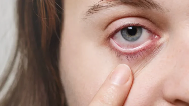 Kenali 4 Penyakit Mata yang Menular
