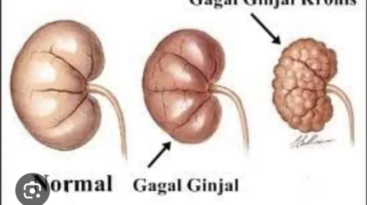 Penyebab Ginjal Orang Indonesia Cepat Rusak