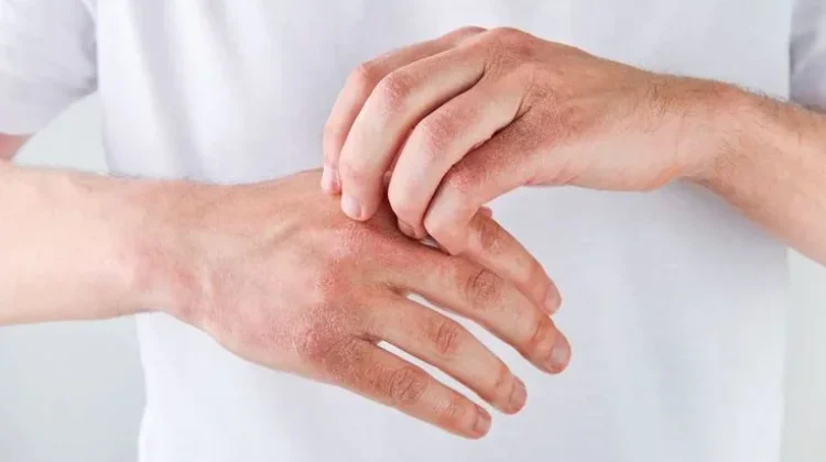 Berikut Tips Merawat Kulit Kering yang Wajib Anda Coba