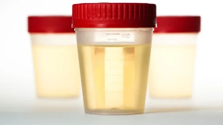 Warna Urine Bisa Jadi Petunjuk Kondisi Kesehatan Ginjal Anda