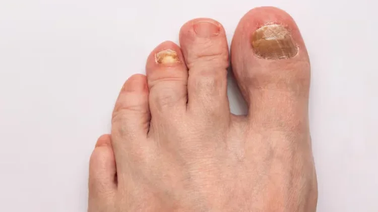 Penyebab Jamur Kaki yang Perlu Dihindari